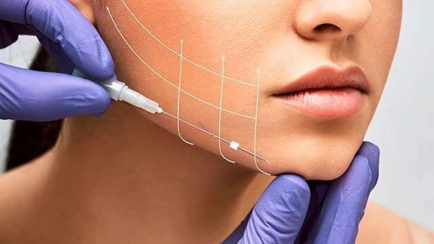 Hilos tensores: ¿En qué consiste esta técnica anti-envejecimiento sin cirugía?