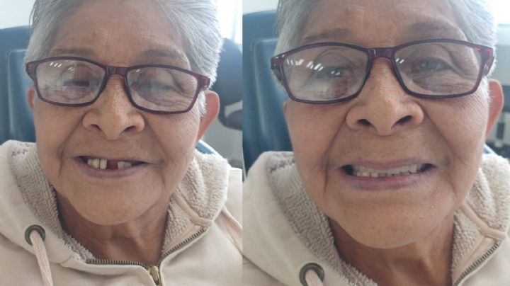 CDMX le regresa las sonrisas a los abuelitos con prótesis gratuitas; así es el registro