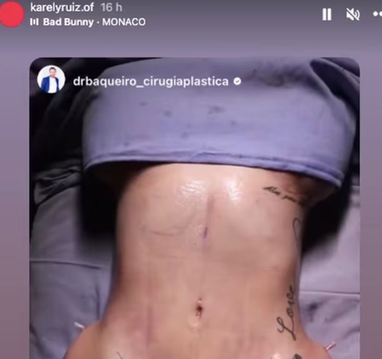 Karely Ruiz cirugía
