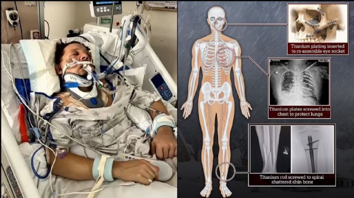 Actor se debate entre la vida y la muerte tras ser atropellado; presenta diversas fracturas