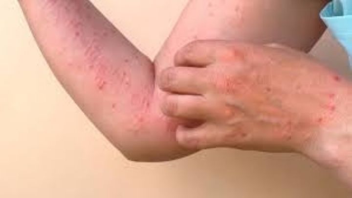 Mpox: ¡Enhorabuena! OMS elimina emergencia internacional por viruela del mono a casi un año de alerta