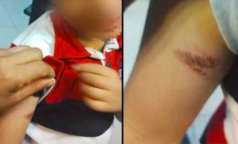 Herida menor de edad 