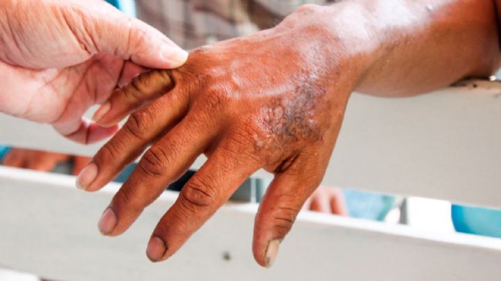 México en alerta por más casos de lepra: ¿Cómo se contagia esta enfermedad? Vigilan 12 municipios