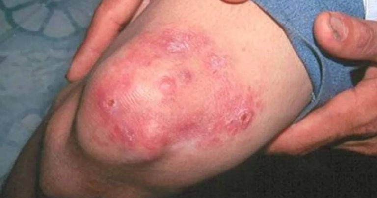 Casos de lepra en México