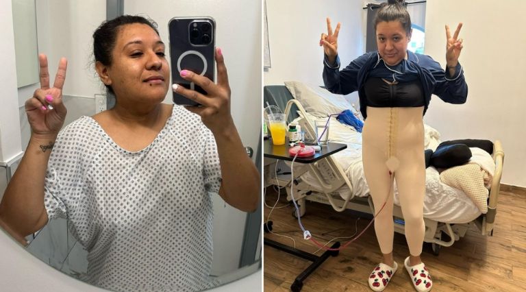 'Omi' tras la liposucción