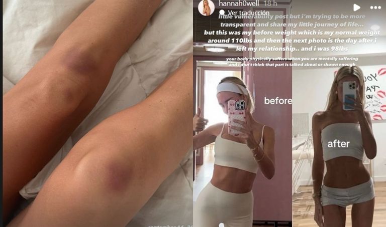 Exnovia de Peso Pluma revela las supuestas secuelas físicas que sufrió