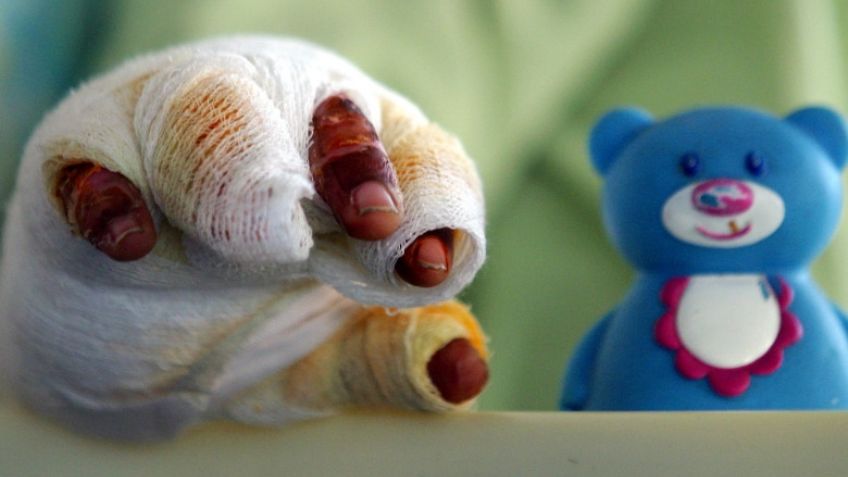 Esto pasará con los tres hermanos que tuvieron quemaduras graves en Ciudad Obregón