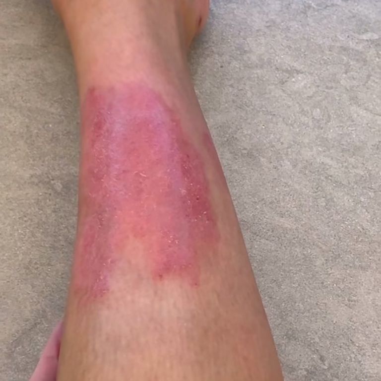 Psoriasis de Kim Kardashian