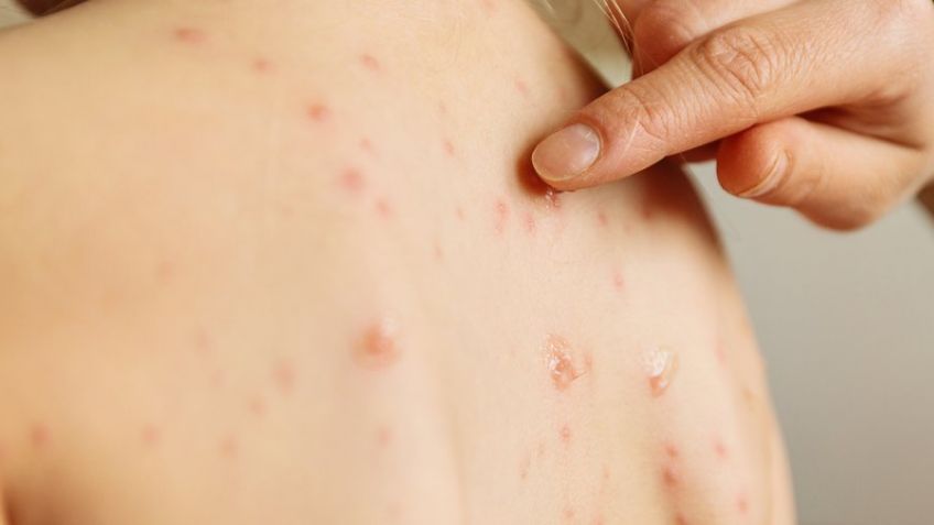 Por brote de sarampión, UNAM emite medidas preventivas para evitar contagios