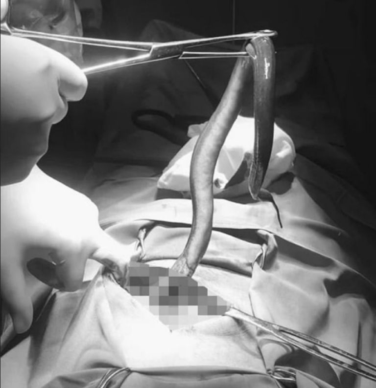 Hallan una anguila dentro del cuerpo de un hombre