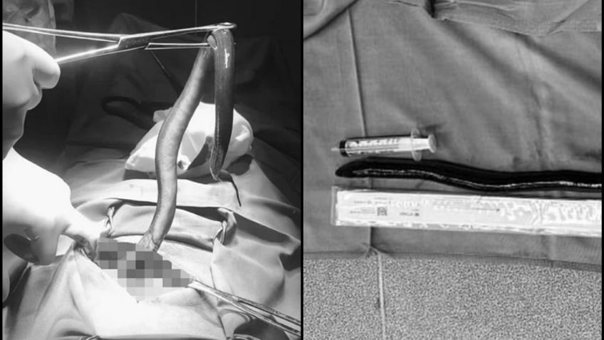De terror: Hombre en Vietnam se queja de dolor abdominal; tenía un anguila viva en su interior