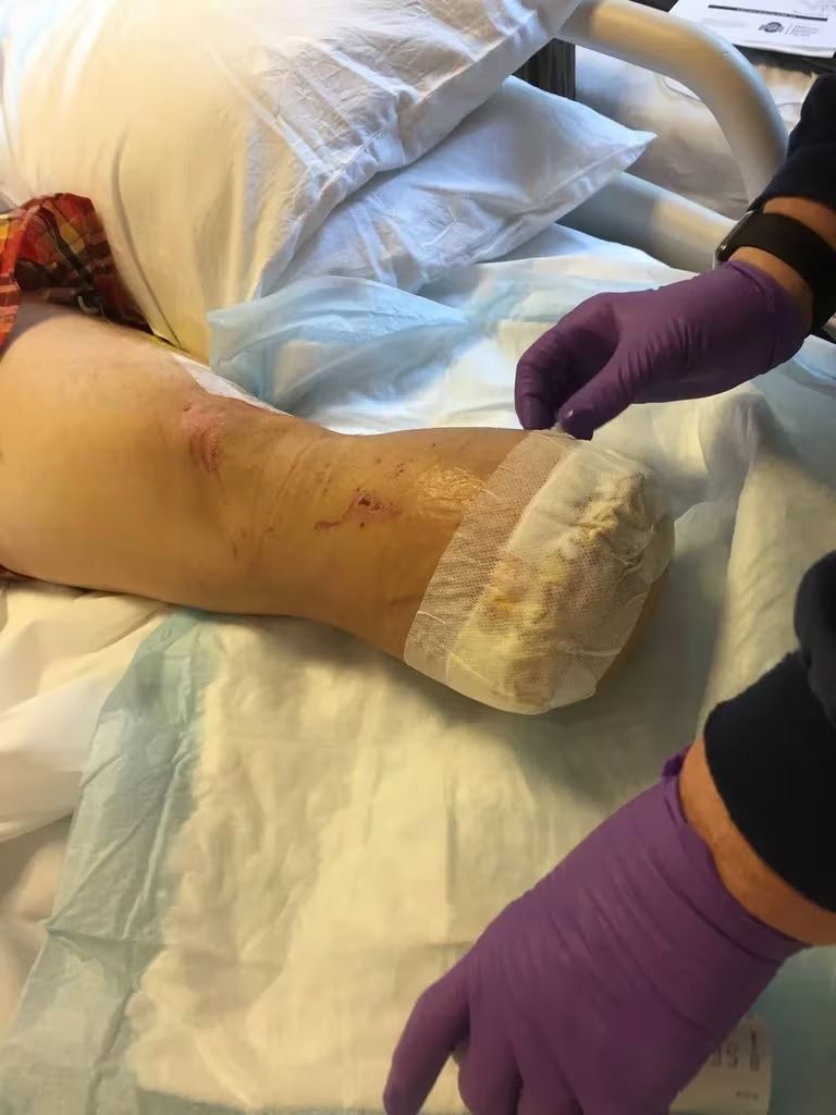 Estudiante de Taiwán Amputa sus Piernas en Intento de Estafa a Aseguradoras: Arrestado por Fraude