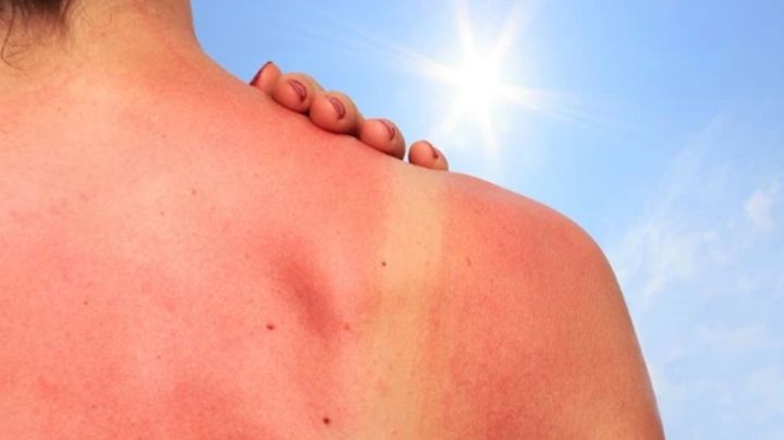 Secretaría de Salud emite advertencia por rayos UV; así puedes evitar el cáncer