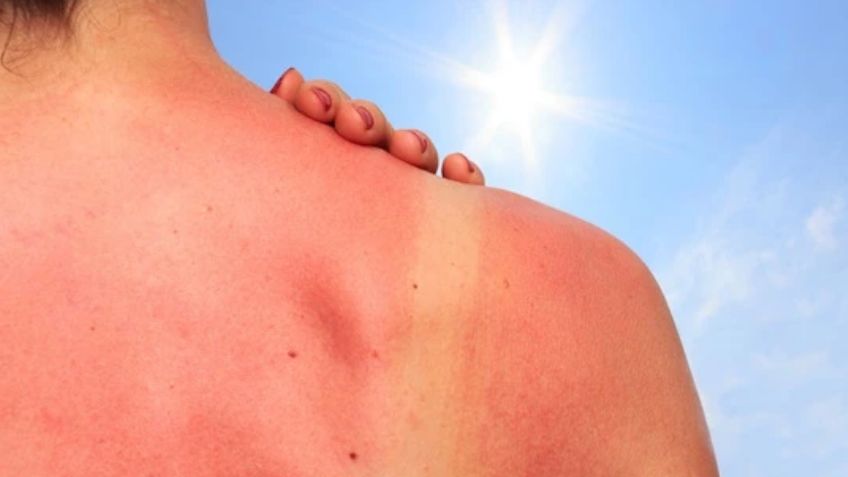 Secretaría de Salud emite advertencia por rayos UV; así puedes evitar el cáncer