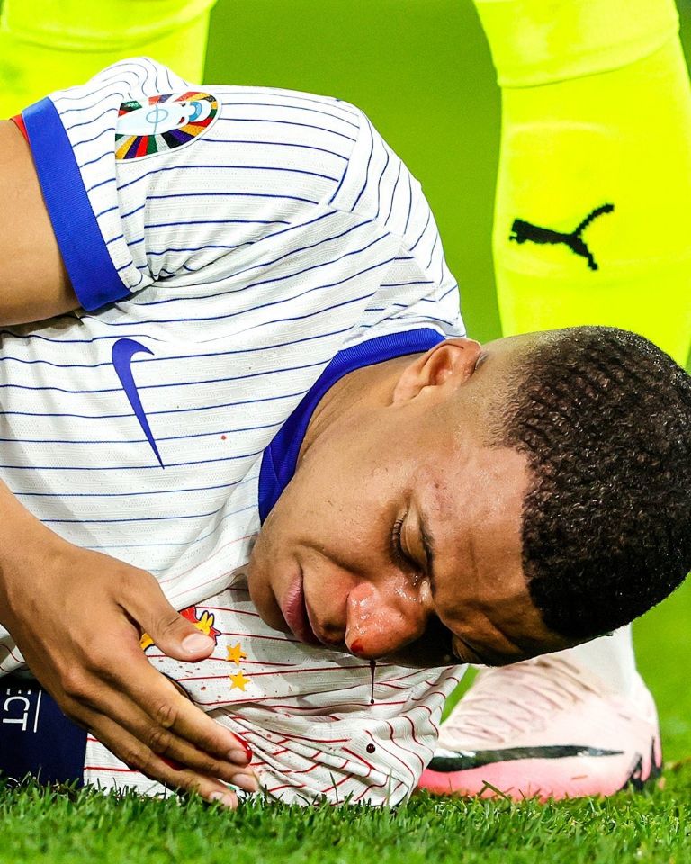 Fractura de Kylian Mbappé