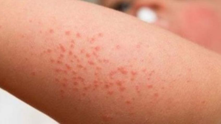 Detectan 3 casos de coxsackie en niños de kínder; autoridades de Toluca toman medidas