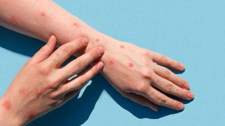 Terrible: Detectan nuevo caso de viruela del mono en Tamaulipas; esto se sabe