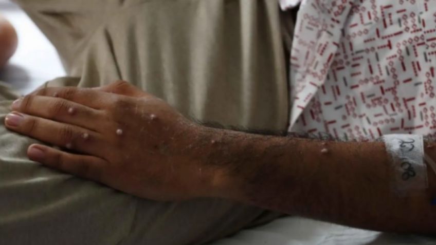 Emergencia global: Detectan propagación rápida y mayor letalidad de viruela del mono