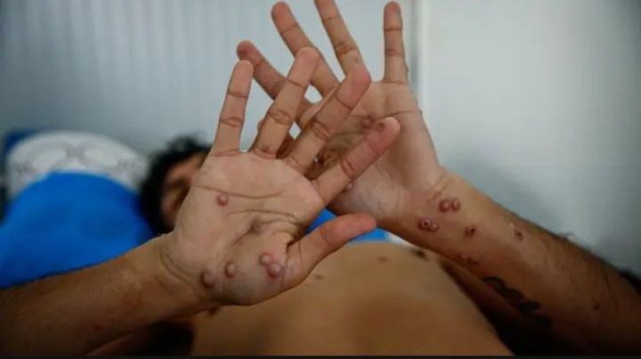 Viruela de Mono llega a Europa; confirman primer caso de la enfermedad en Suecia