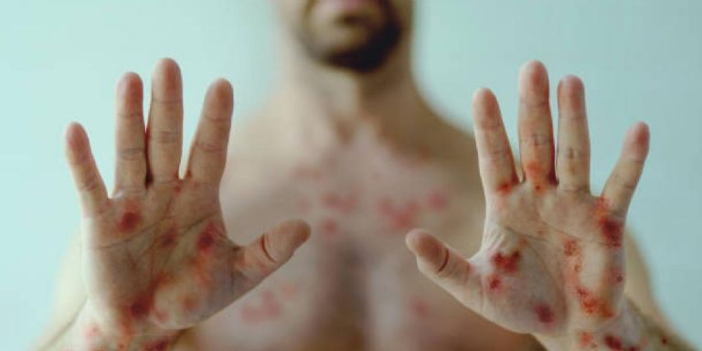 La Viruela de Mono se propaga