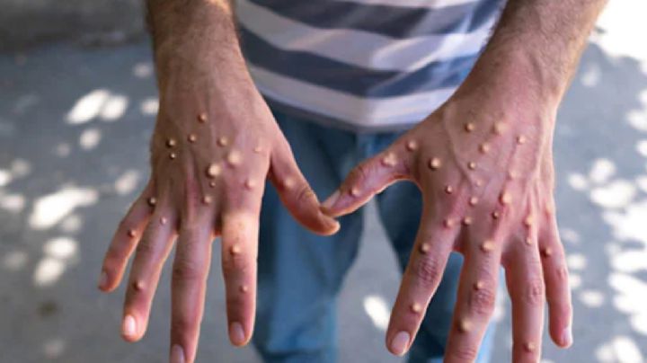 53 casos de mpox en México; causa alerta que el país no cuenta con vacunas