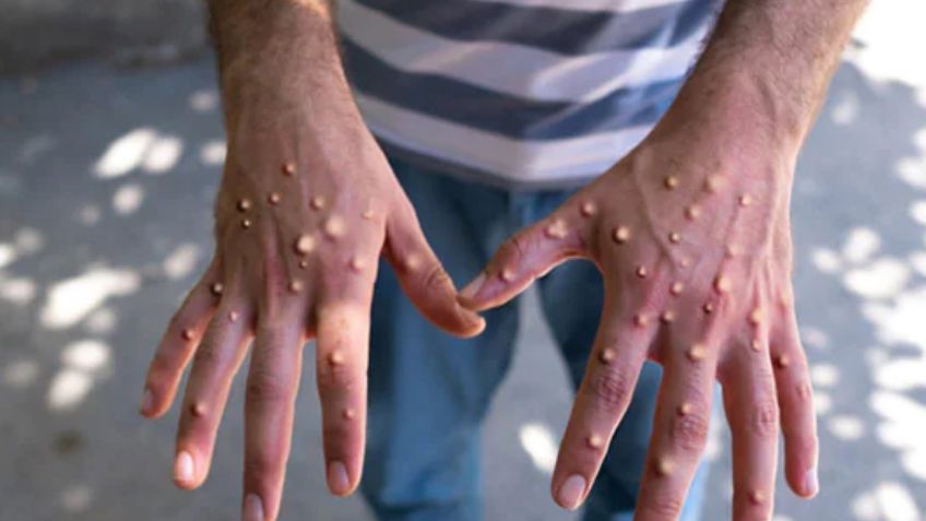 53 casos de mpox en México; causa alerta que el país no cuenta con vacunas
