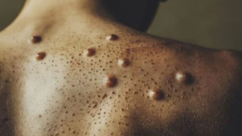 Protégete: IMSS-Bienestar emite 7 medidas preventivas para no contagiarse de mpox