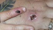 Foto ilustrativa de la nota titulada Viruela del mono en Sonora: Salud confirma hombre y mujer contagiados de MPOX