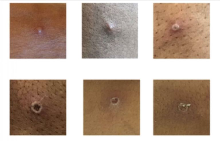 Confirman casos de viruela del mono en Sonora. Foto: Internet