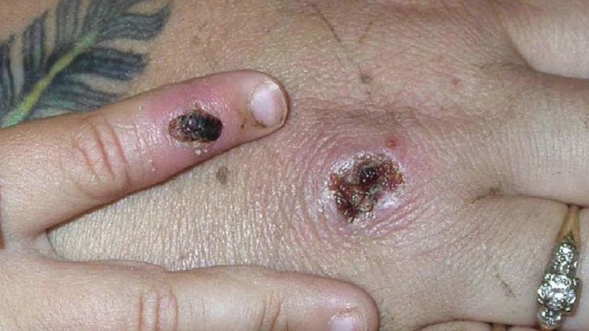 Viruela del mono en Sonora: Salud confirma hombre y mujer contagiados de MPOX