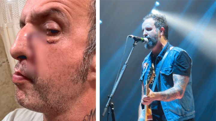 Molotov: Tito Fuentes revela cómo quedó su rostro tras coma y cirugías por adicciones