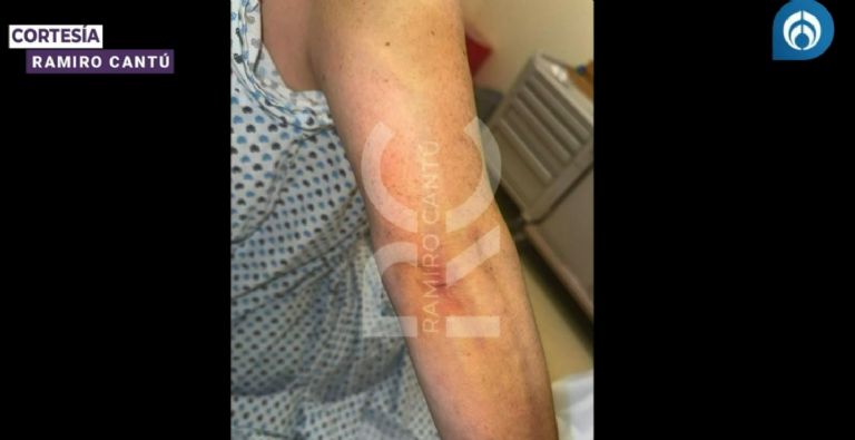 El brazo de Alicia Villarreal tras la supuesta agresión de Cruz Martínez