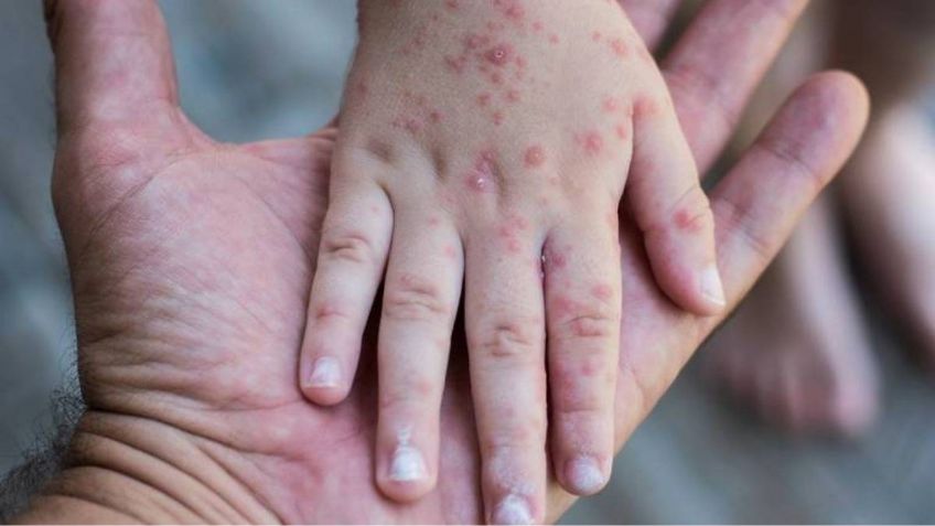 Sarampión en México: Estos son los síntomas de alerta; aumentan los casos
