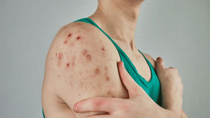 Sonora: Confirman primer caso de sarampión, se trata de una mujer que viajó a Chihuahua