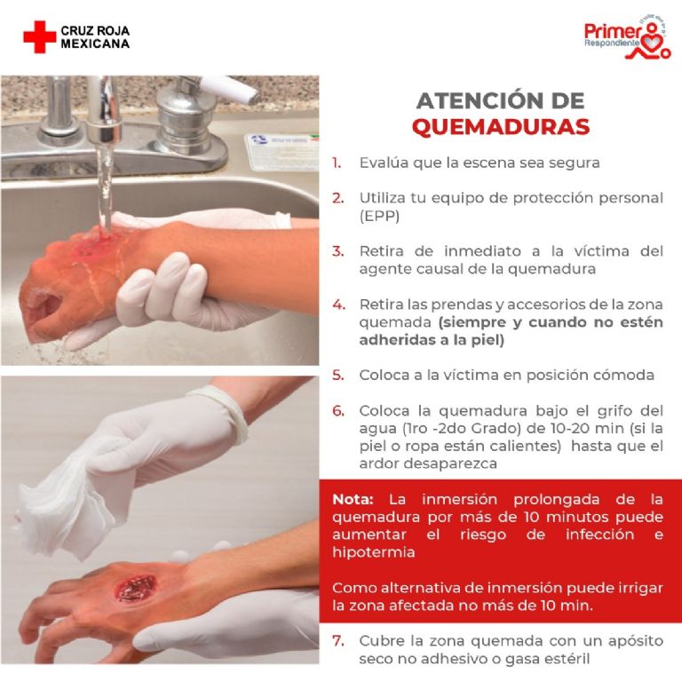 Recomendaciones para evitar quemaduras 