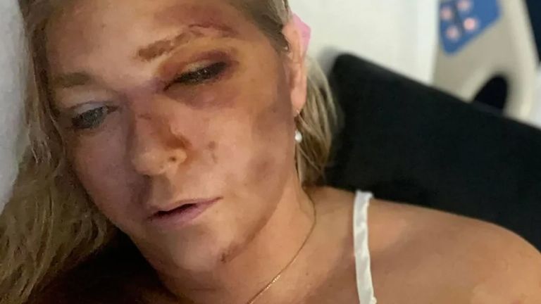 Virginia Giuffre había sufrido un accidente a finales del mes de marzo