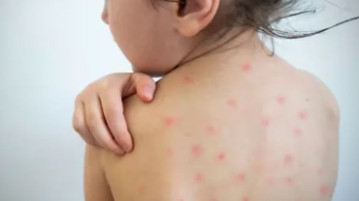 Navojoa en ‘focos amarillos’ por casos sospechosos de sarampión