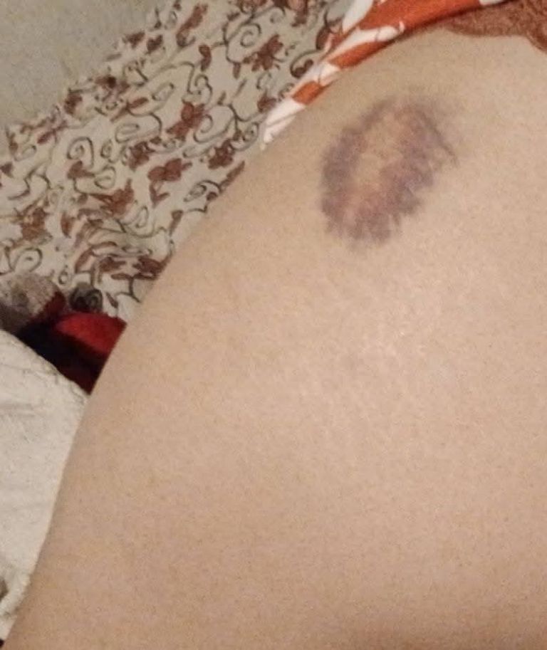 La víctima compartió una foto de sus lesiones. Foto: Facebook