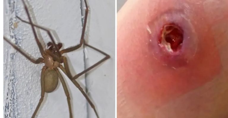 Signos de alerta ante una picadura de araña violinista