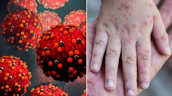 Sonora confirma primer caso de sarampión en Hermosillo en persona con antecedentes de viaje