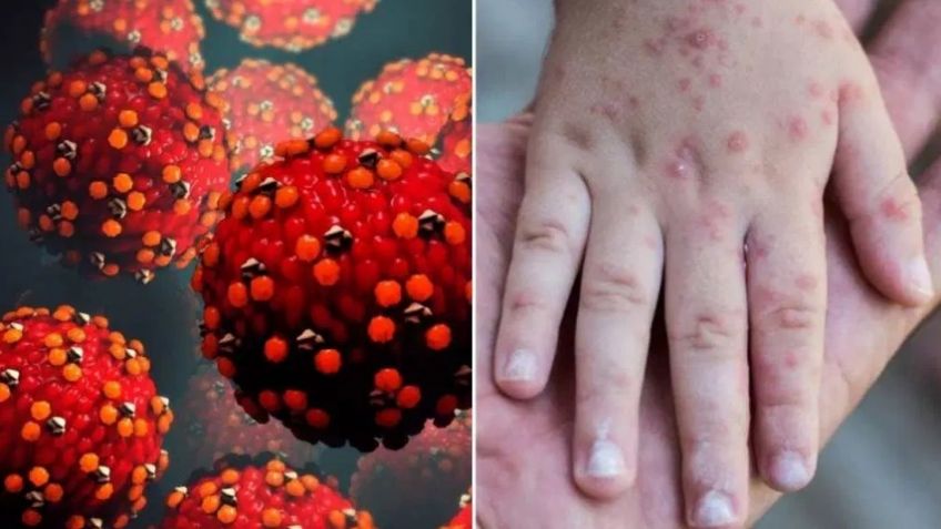 Sonora confirma primer caso de sarampión en Hermosillo en persona con antecedentes de viaje