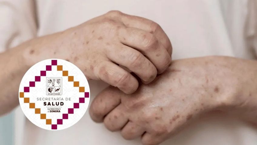 Supervisa SEC que no se desarrollen brotes de sarampión en escuelas de Sonora