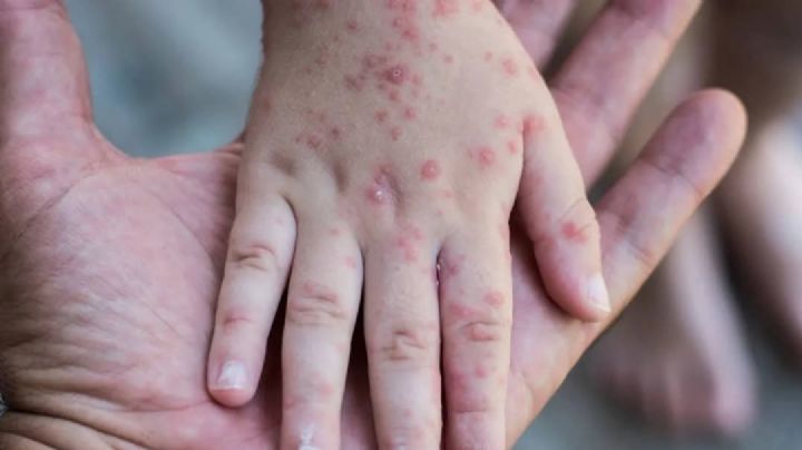 No bajar la guardia piden autoridades tras primera muerte por sarampión en Ciudad Obregón