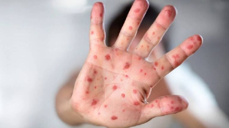 No bajar la guardia piden autoridades tras primera muerte por sarampión en Ciudad Obregón