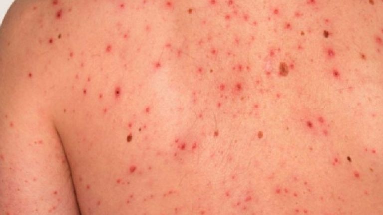 Libre de sarampión, cárcel de Cajeme