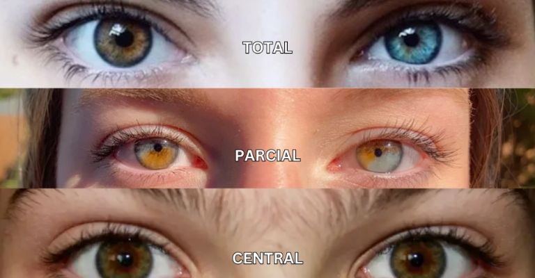 Tipos de heterocromía