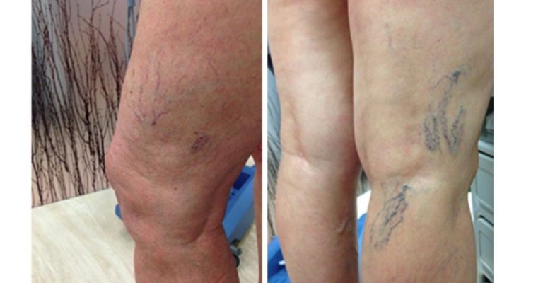 Aplica estas tres vitaminas sobre tus piernas y ‘chamorros’ para eliminar varices y ‘arañitas’ de forma eficaz