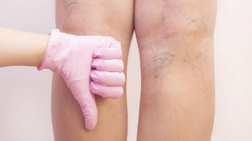 ¿Problemas de varices? Estas 3 vitaminas para piernas y ‘chamorros’  son la solución