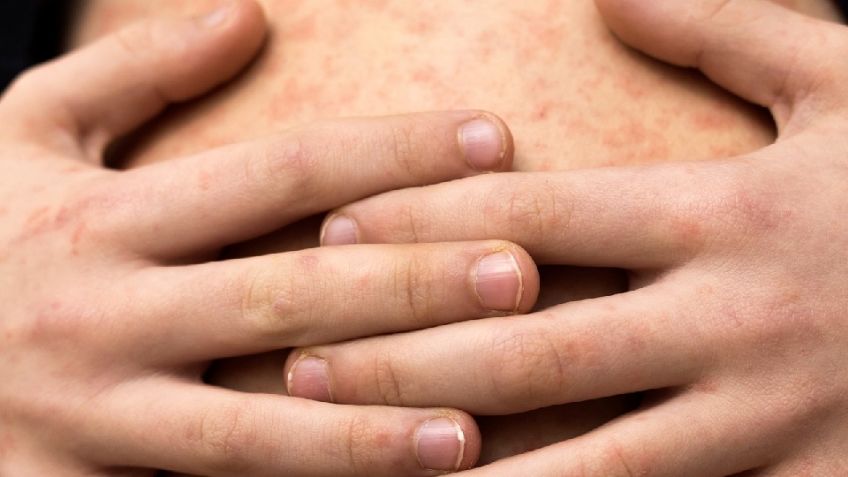 México se ubica en segundo lugar por muertes de sarampión en América después de Canadá