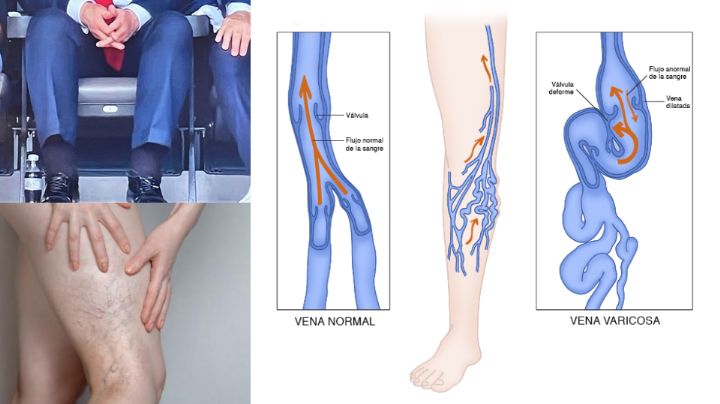 Insuficiencia venosa: ¿Cómo es la enfermedad que le han diagnosticado a Donald Trump?